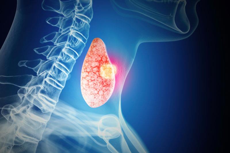 Cancro metastatico della tiroide e cosa devi sapere