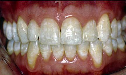 Enamel: The strongest structure in the body!