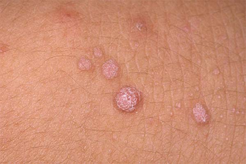 Penile fungus and necessary information Penile fungus and necessary information