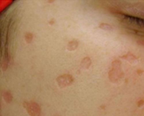 Comment éviter les cicatrices après la varicelle ?