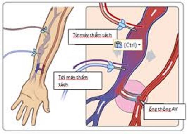 Arterioveneuze fistel: begrip voor een juiste behandeling!