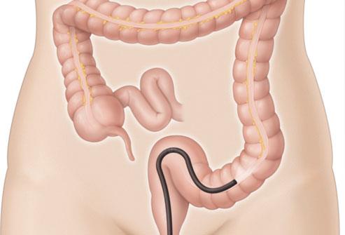 Síndrome da úlcera retal isolada: sinais, causas, diagnóstico e tratamento
