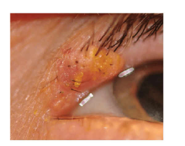 Sebasöz karsinom: Ölümcül göz kapağı tümörü