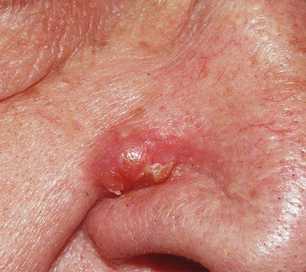 Sista epidermoid: Jenis sista yang paling biasa pada kulit