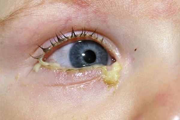 Obstruction of the lacrimal gland in children