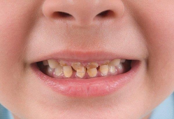 어린이의 노랗고 변색 된 치아 : 원인, 치료 및 예방