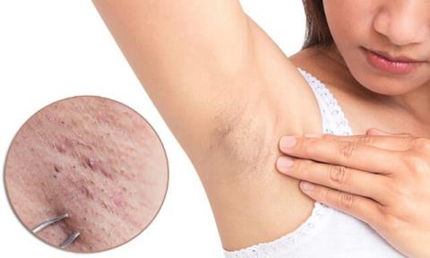 Inflammation of the sweat glands in the armpit: no ones pain alone