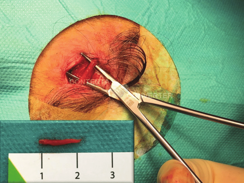 Височный артериит: странное заболевание с потенциальным риском