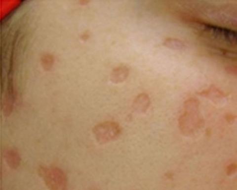 How to avoid scarring after chickenpox?