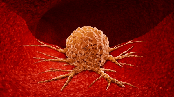 軟骨芽細胞腫：穏やかな癌！