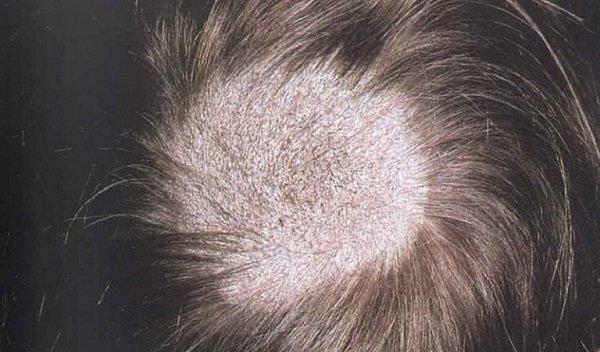 首の後ろのリンパ節の腫れ：この兆候について知っておくべき真実