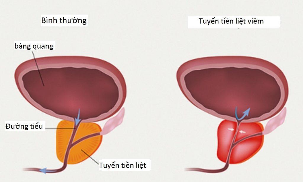 Prostate cyst: The pathology cannot be subjective