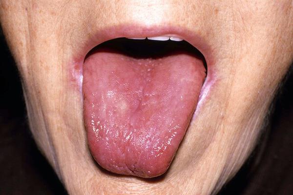 What do tongue diseases say about your health?