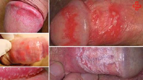 Inflammation of the penis: a warning sign of a dangerous disease