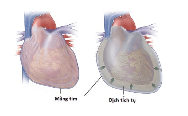 ドレスラー症候群：心臓損傷後の合併症とあなたが知る必要があること