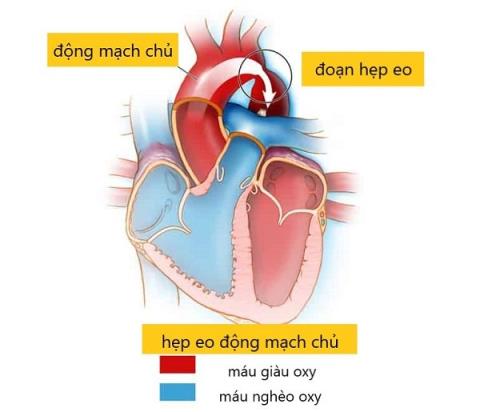 Coarctation ของหลอดเลือดแดงใหญ่: โรคหัวใจพิการ แต่กำเนิดเป็นเรื่องง่ายที่จะพลาด