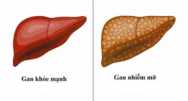 Hígado graso y lo que necesitas saber