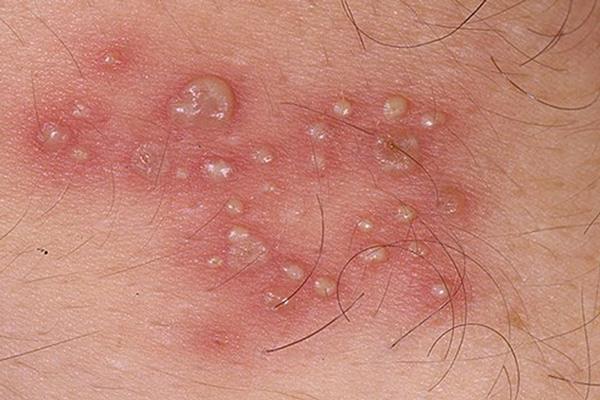 睾丸上長痘痘是什麼病的徵兆？