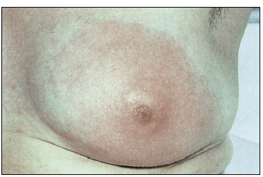 Dilated mammary ducts: Women's worries