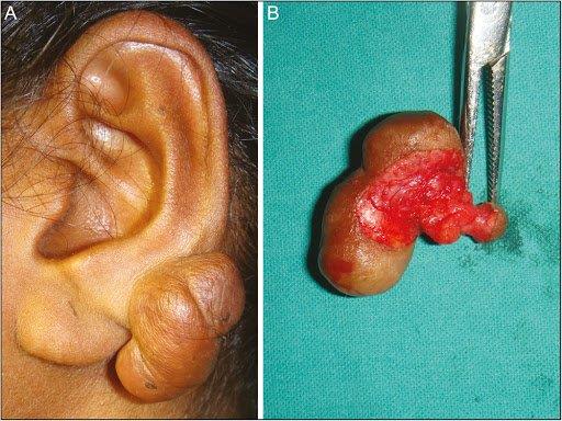 What is an ear keloid?  Can it be cured?
