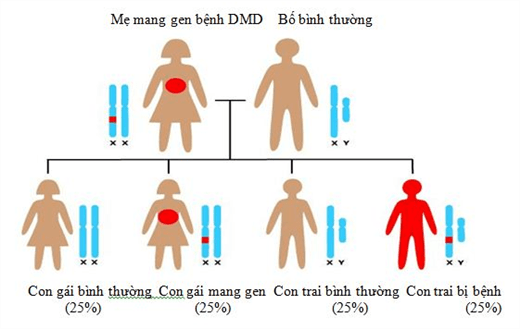 Duchenne-Muskeldystrophie: gefährliche erbliche Muskeldystrophie