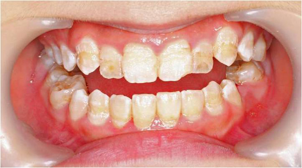 子供の黄色く変色した歯：原因、治療および予防