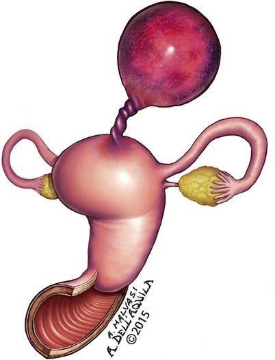 Când devin periculoase fibromul uterin?