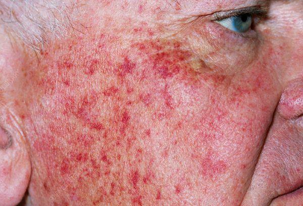 Rosacea: Causes, Symptoms and Diagnosis