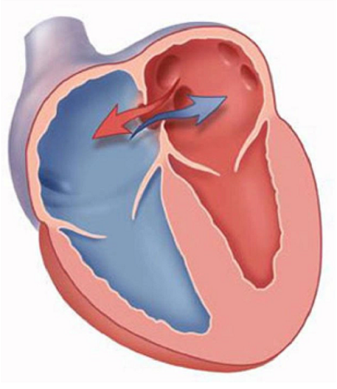 What you need to know about atrial septal defect