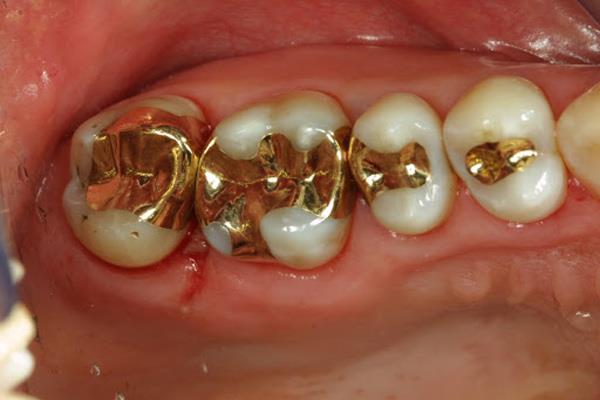 Зубные пломбы и что нужно знать