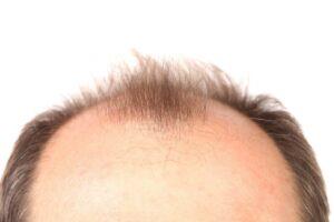 Can baldness be cured?