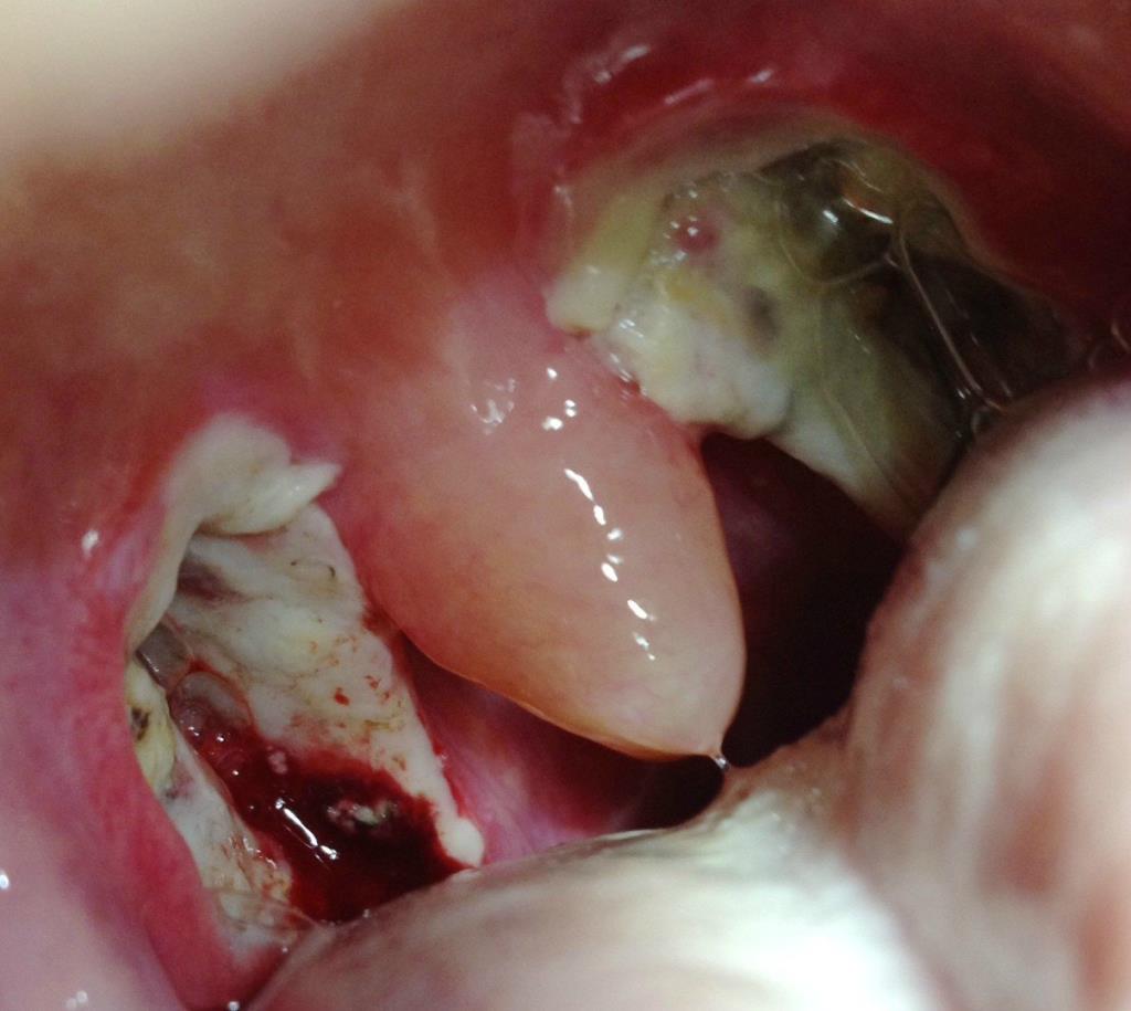 Things to know after tonsillectomy