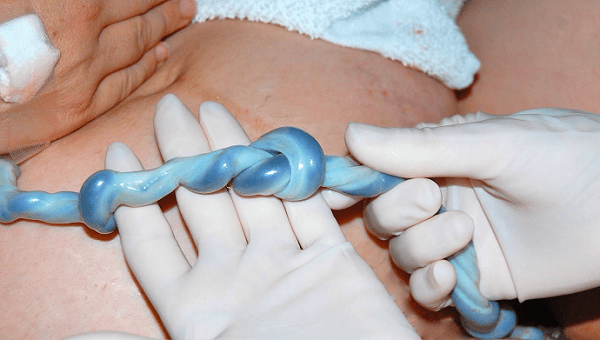 Wat moet een moeder doen als de baby tijdens de zwangerschap een geknoopte navelstreng heeft?