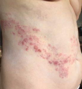 Come evitare di cicatrici dopo la varicella?