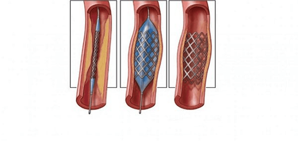 Estenosis de la arteria renal: manifestaciones, diagnóstico y tratamiento.