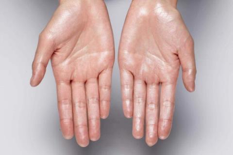 Does Acupuncture for Sweaty Hands Really Work?