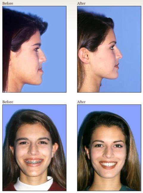 The effect of braces in changing the face
