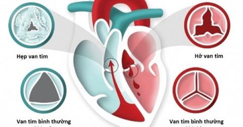 Effective medicinal herbs to treat heart valve regurgitation