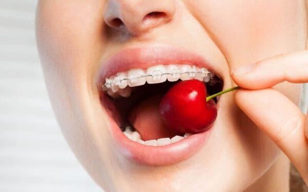 Was essen Menschen mit Zahnspange und was sollten sie nicht essen?
