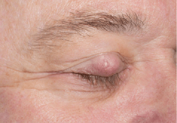 Talgdrüsenkarzinom: Tödlicher Augenlidtumor