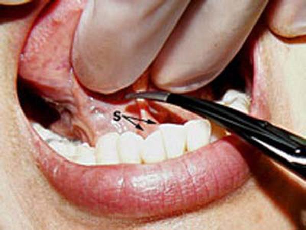 Enfermedad de la lengua pegada: lo que necesita saber