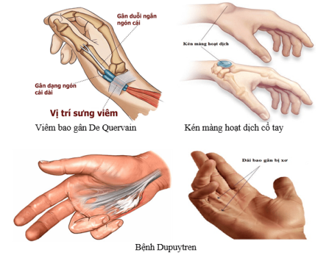 Wrist pain: Common causes