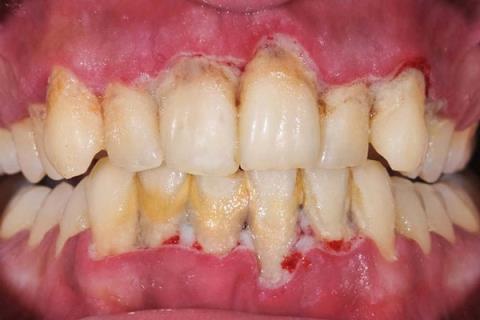 歯茎の出血：口腔の健康の悪い兆候