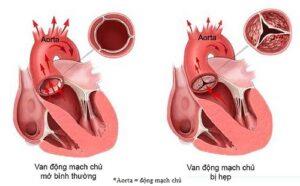 Aortic stenosis: All you need to know