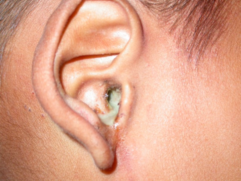 Ear discharge: Common causes