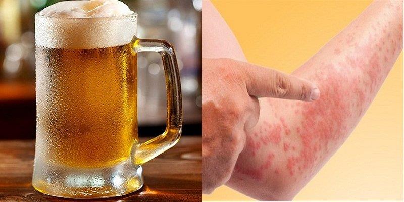 What to do if you have a beer allergy?