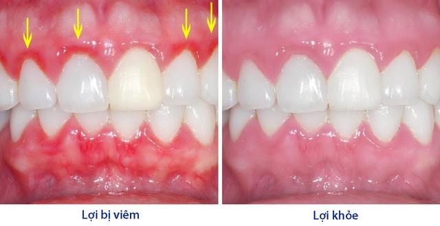 Gums: Important soft tissue that surrounds teeth