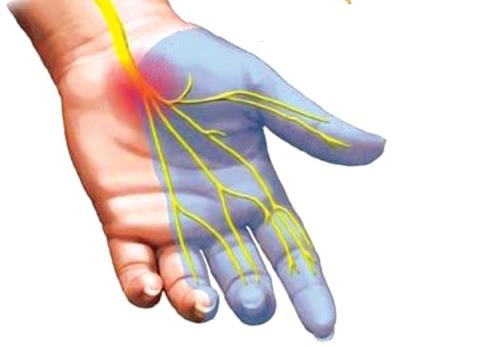 Acupuncture treatment of carpal tunnel syndrome and what you need to know