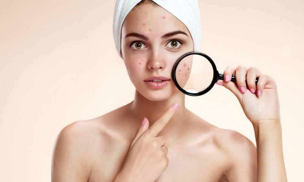 Papulex prodotti per l'acne e cosa devi sapere