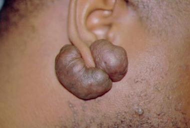 What is an ear keloid?  Can it be cured?